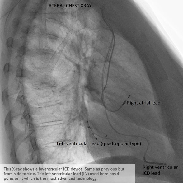 Lateral chest x-ray 1