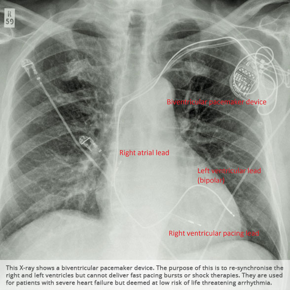 Biventricular pacemaker device
